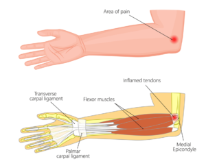 Golfer's Elbow Happens Here